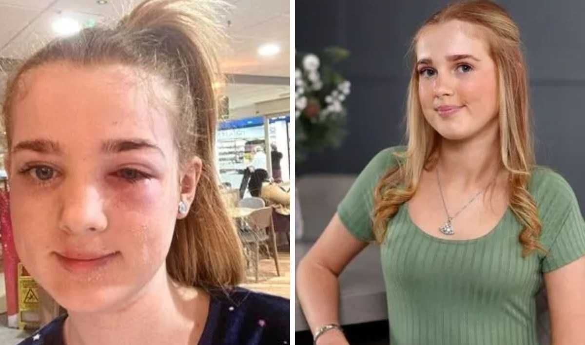 Menina de 13 anos quase fica cega por causa de dica de skincare do TikTok