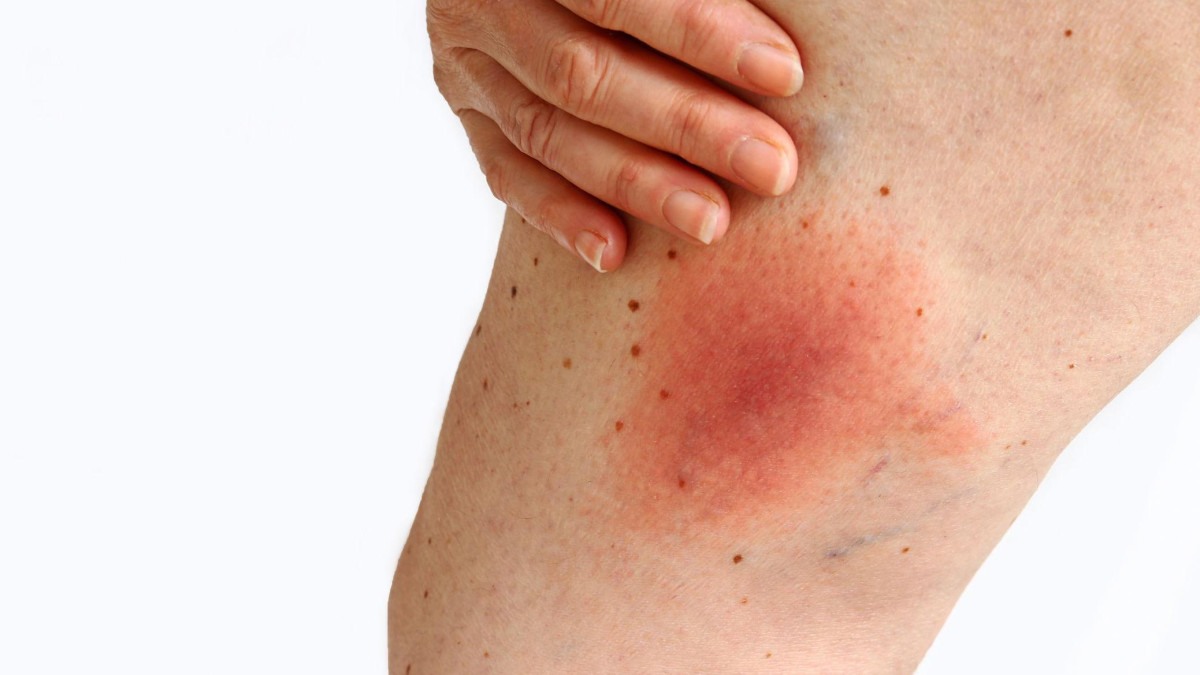 Mancha na pele causada pela doença de Lyme -  (crédito: Getty Images)