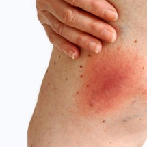 5 sinais na pele que podem indicar problemas de saúde  - Getty Images