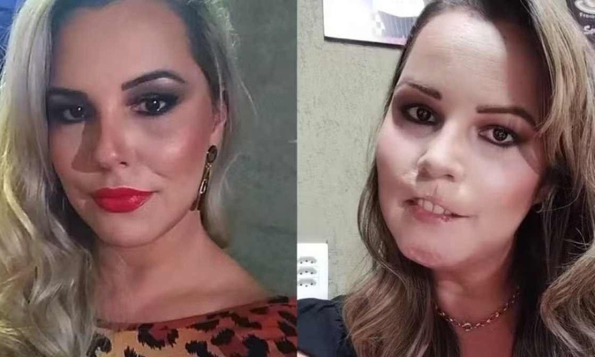 Depois de voltar na profissional que realizou o preenchimento, Mariana recorreu a uma consulta com uma dermatologista que receitou um tratamento com antibióticos e corticoides, que não tiveram efeito -  (crédito: Redes Sociais/ Reprodução)