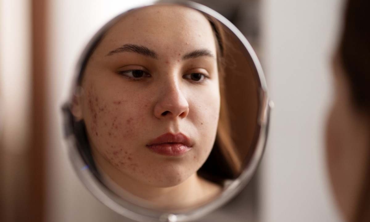 A acne, embora, na maioria dos casos, seja uma doença de fácil controle, é uma doença crônica inflamatória do folículo pilossebáceo, que produz o sebo da pele e, que em excesso, acarreta no surgimento das erupções subcutâneas -  (crédito: Freepik)