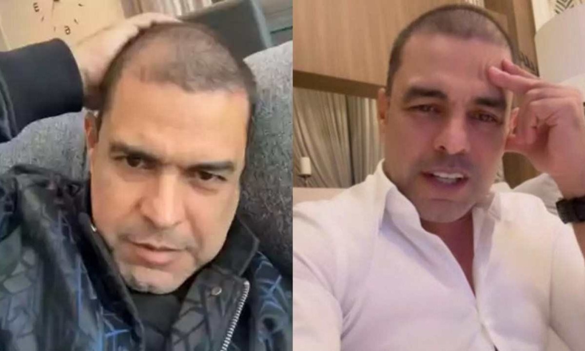 O cantor Zezé di Camargo compartilhou nas redes sociais os resultados de um transplante capilar que realizou devido a um quadro de queda de cabelo -  (crédito: Reprodução/Instagram)