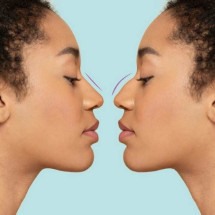 8 correções no nariz que podem ser feitas com a rinoplastia - Freepik