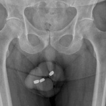 Idoso põe 3 baterias no pênis e ação provoca necrose da uretra -  Urology Case Reports/Reprodução