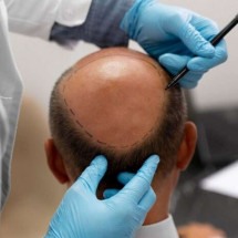 Queda de cabelo: busca por transplante capilar cresce exponencialmente entre os homens - Freepik