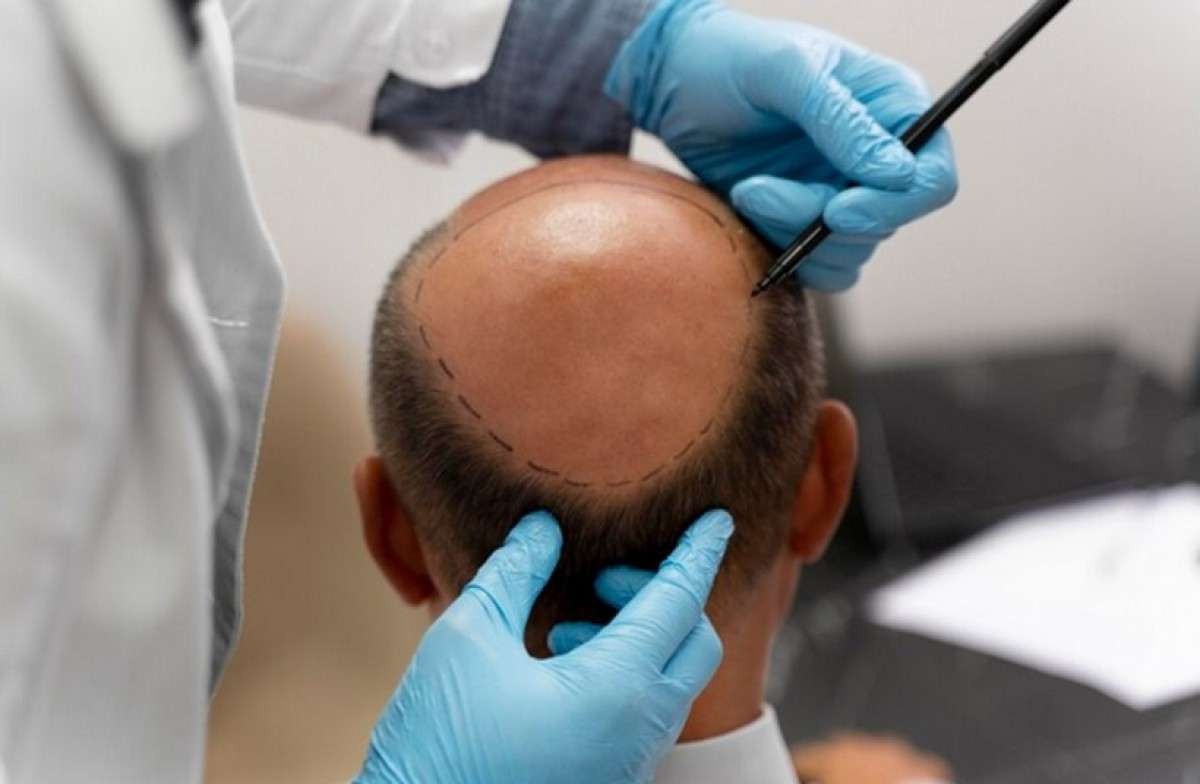 Queda de cabelo: busca por transplante capilar cresce exponencialmente entre os homens