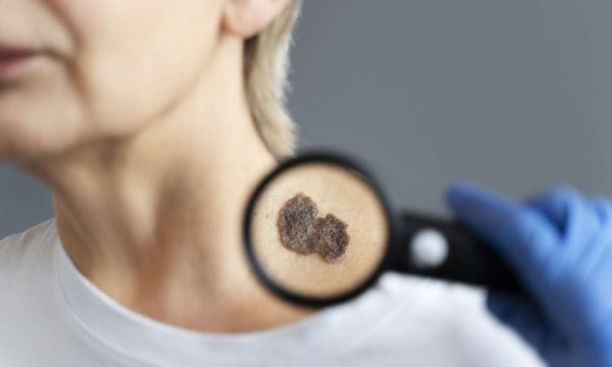 Os melanomas podem ser na cor marrom, irregulares ou planos, e caroços pretos ou cinzentos  -  (crédito: Freepik/Divulgação)