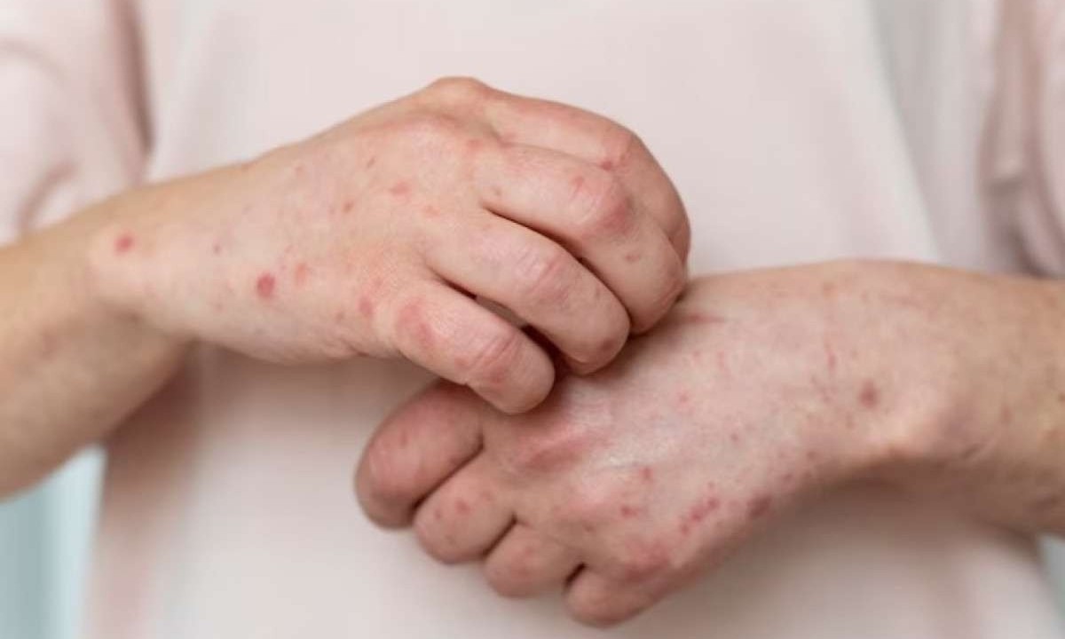 O herpes zoster não é uma doença muito contagiosa, mas o vírus varicela zoster pode ser transmitido através do contato direto com as lesões da pele da pessoa infectada -  (crédito: freepik)