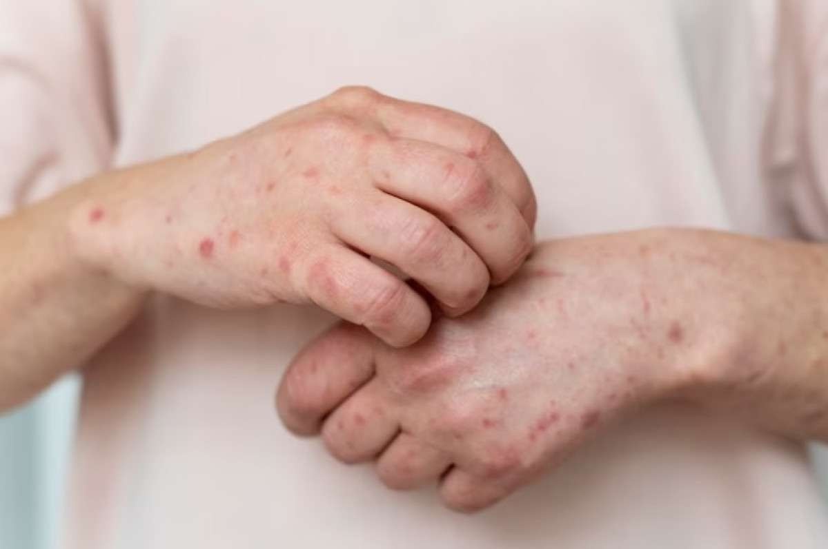 alergia cutânea no braço de uma pessoa
