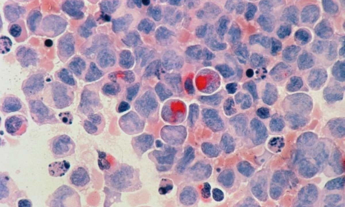 O tumor afeta os glóbulos brancos do sangue, responsáveis por defender o corpo contra organismos infecciosos e substâncias estranhas -  (crédito:  National Cancer Institute/Unsplash)