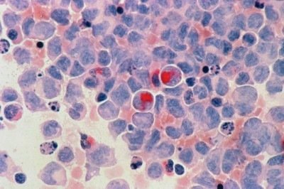 O tumor afeta os glóbulos brancos do sangue, responsáveis por defender o corpo contra organismos infecciosos e substâncias estranhas -  (crédito:  National Cancer Institute/Unsplash)