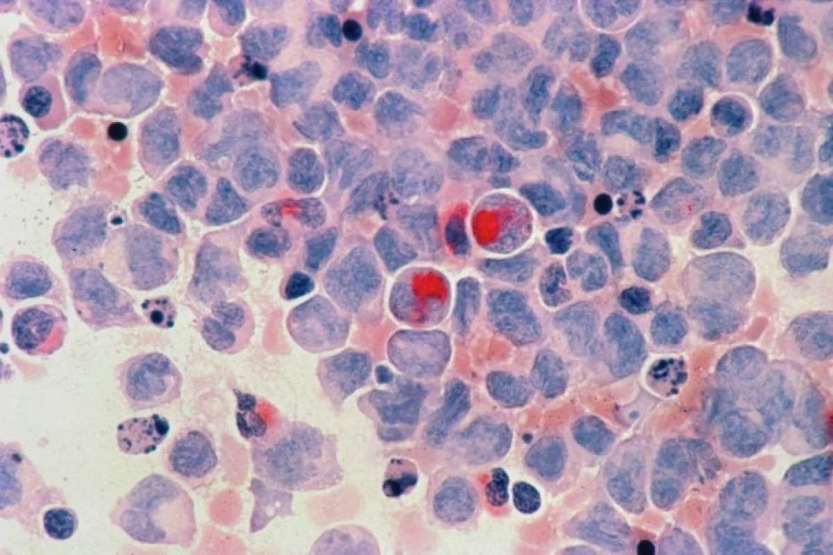 Leucemia: Inca estima 11 mil novos casos em 2024