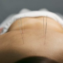 Especialista responde as 7 principais dúvidas sobre a acupuntura; técnica é aliada no tratamento de doenças autoimunes  - Freepik
