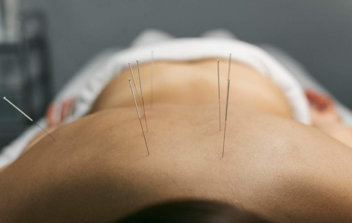 Especialista responde as 7 principais dúvidas sobre a acupuntura; técnica é aliada no tratamento de doenças autoimunes 