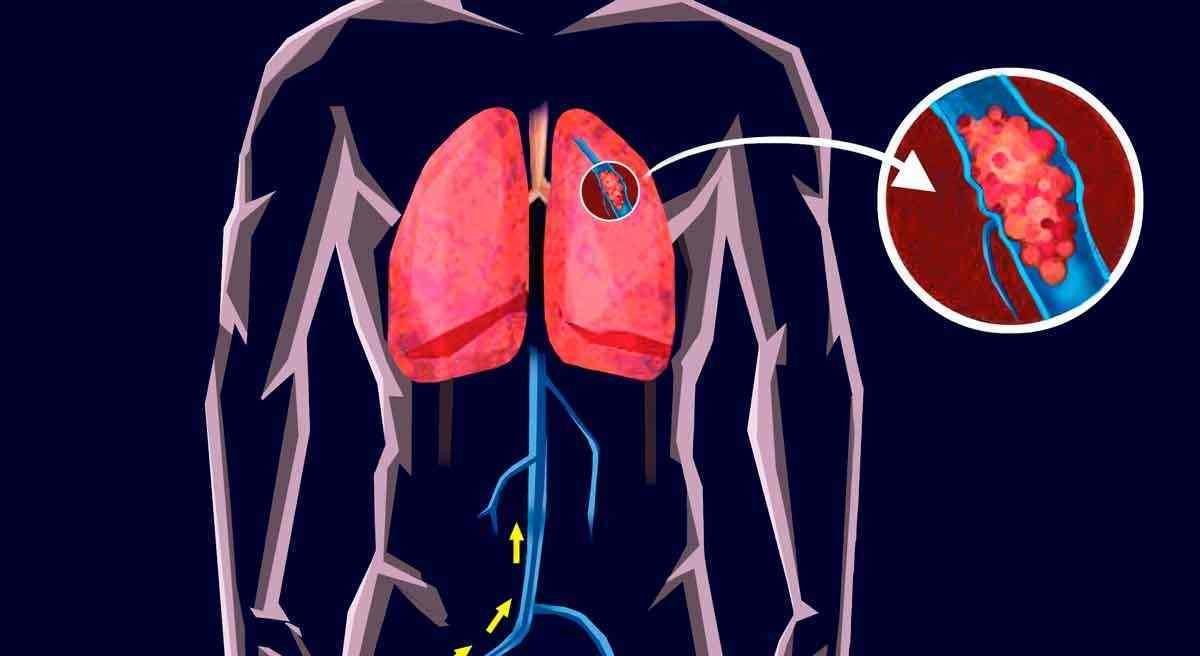 Evite a embolia pulmonar que ocorre durante as viagens de avião