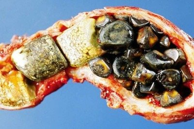 Pedra na vesícula: a prevenção exige medidas comportamentais como dietas, medicamentos podem ser usados no tratamento, sendo o mais eficiente e usado atualmente, a cirurgia -  (crédito: Adim/Divulgação)