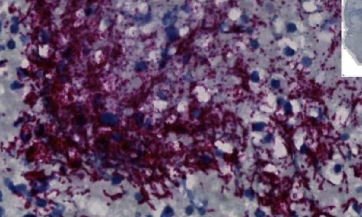 Uma imagem de microscópio mostra um tumor de câncer colorretal humano com Fusobacterium nucleatum corado em uma cor vermelho-púrpura. A bactéria é comumente encontrada na boca das pessoas. Os pesquisadores da Fred Hutch descobriram um subtipo específico de F. nucleatum que pode se mover para o intestino, onde ajuda o câncer colorretal a crescer. CRÉDITO Centro de Câncer Fred Hutchinson -  (crédito: Fred Hutchinson Cancer Center/Divulgação)