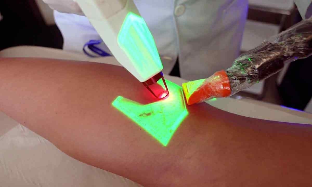 Tratamentos a laser de problemas vasculares têm se tornado frequentes no país
 -  (crédito: YouTube/reprodução)