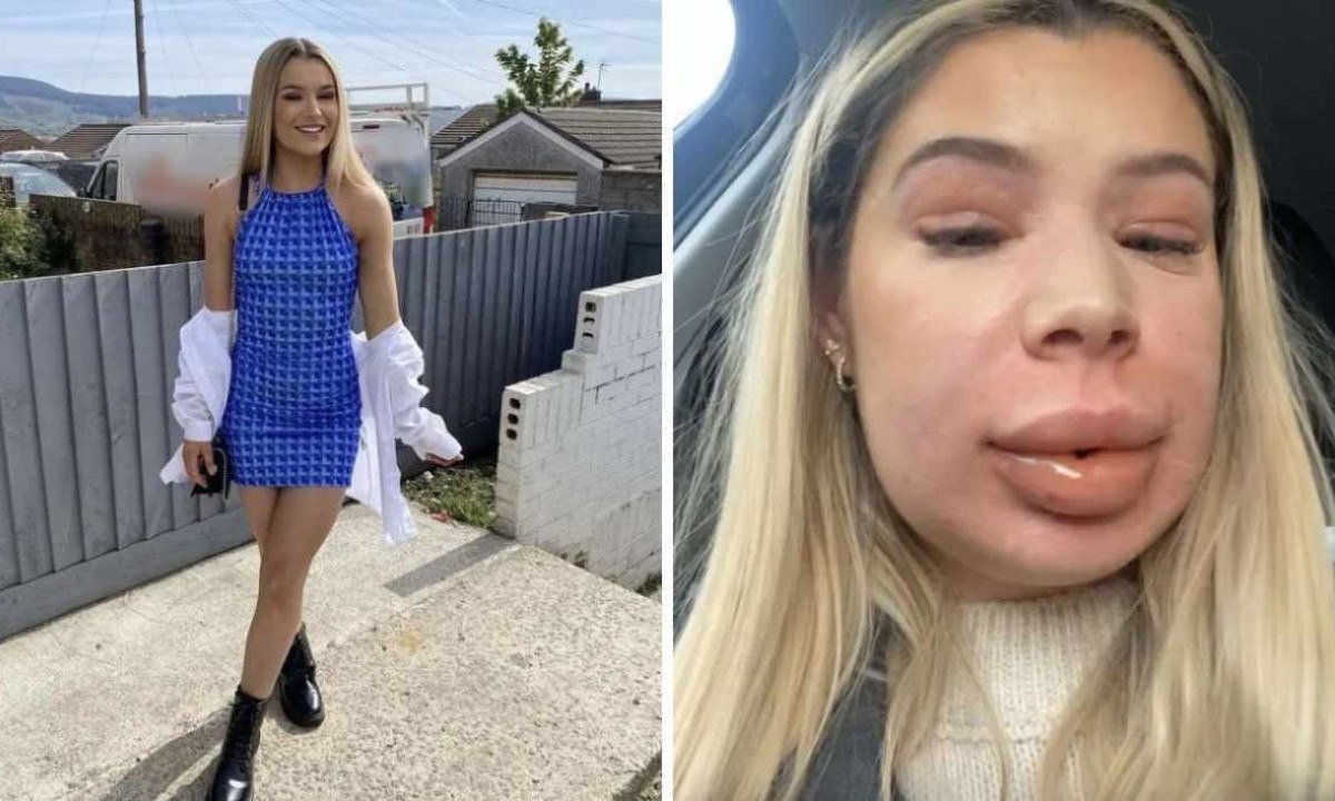  Shaunna Harris, de 24 anos, decidiu remover o preenchimento antes de fazer novo procedimento labial, mas teve reação alérgica -  (crédito: Reprodução)