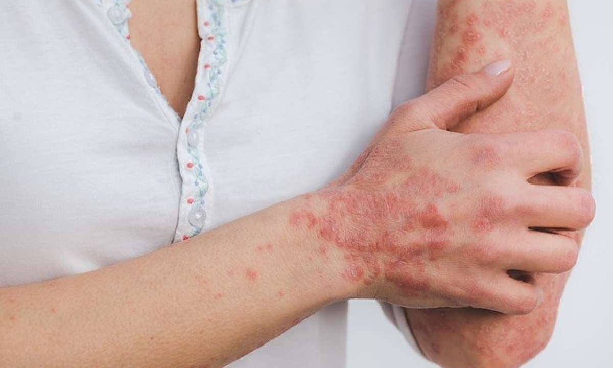 
Mancha avermelhadas com escamas esbranquiçadas ou prateadas, pequenas manchas brancas ou escuras residuais pós lesões, ressecamento e rachaduras, são alguns sinais que a pele dá quando sofre com a psoríase -  (crédito: Eszter Miller/Pixabay)