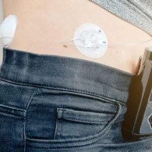 Diabetes: Reino Unido se torna 1º a oferecer 'pâncreas artificial' na rede pública - BBC