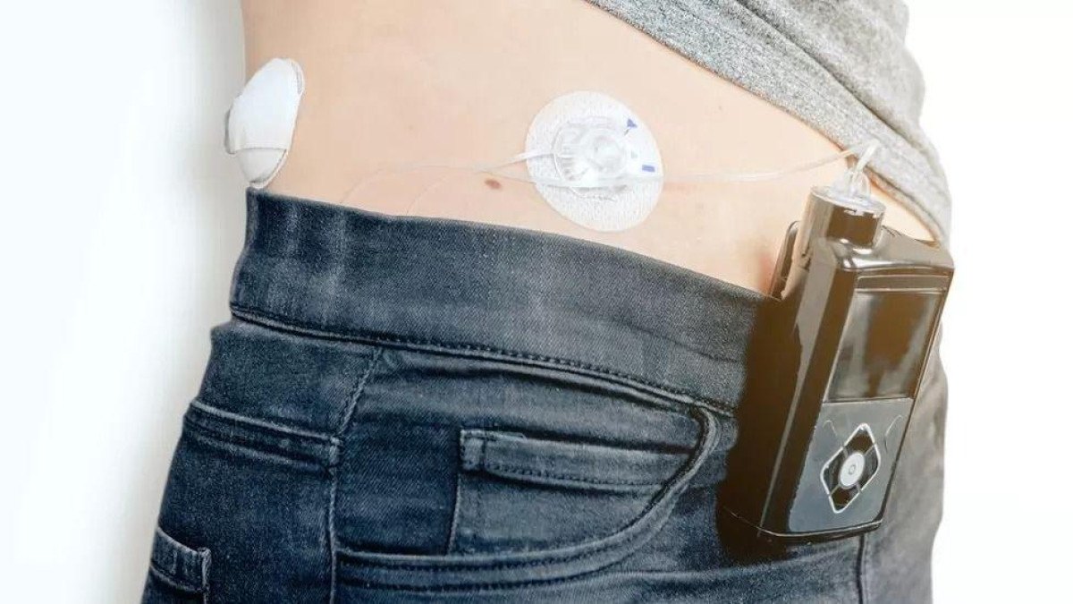 Diabetes: Reino Unido se torna 1º a oferecer 'pâncreas artificial' na rede pública