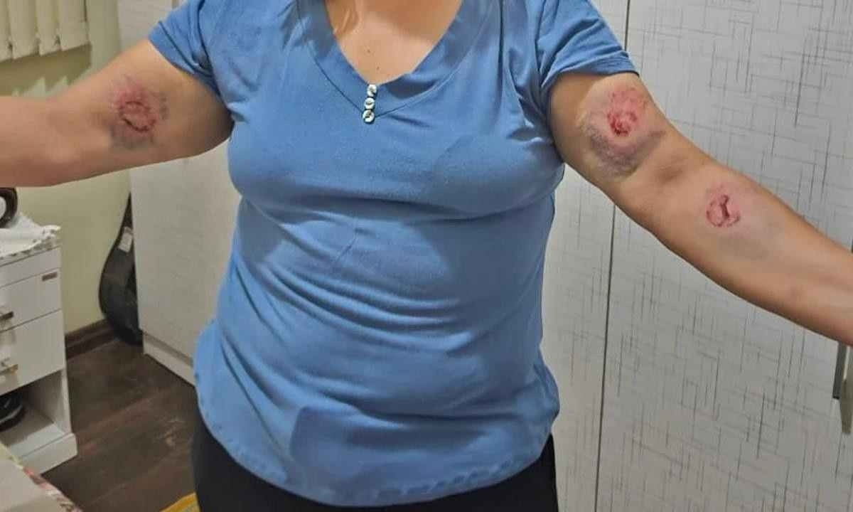 A professora foi agredida com mordidas pelo aluno de 11 anos -  (crédito: Reprodução Redes Sociais)