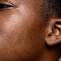 Manchas e acnes: pele negra tem mais propensão de tê-las; confira cuidados essenciais - Freepik