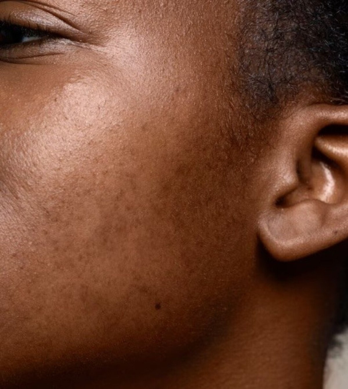 Manchas e acnes: pele negra tem mais propensão de tê-las; confira cuidados essenciais