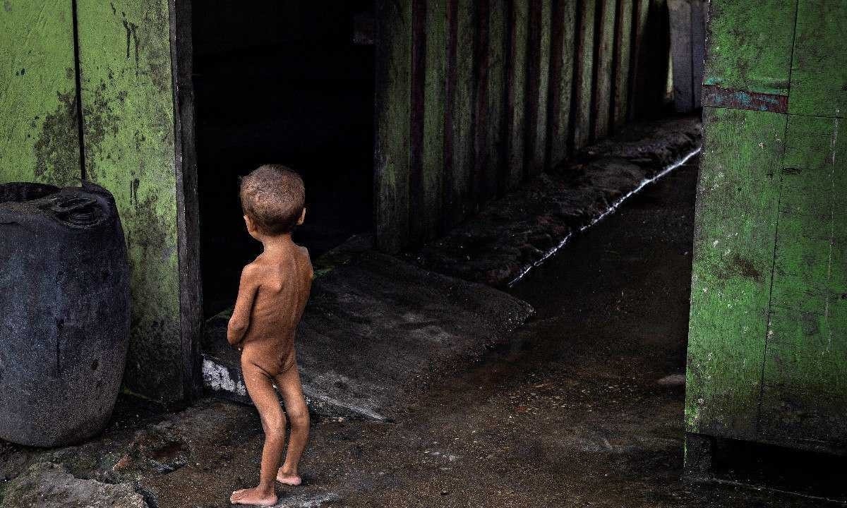 Criança yanomami com desnutrição grave, internada no Polo Base de Surucucu, na Terra Indígena Yanomami, em Roraima, em fevereiro de 2024 -  (crédito: Lalo de Almeida/Folhapress)