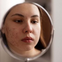 Não são só espinhas: como a acne pode prejudicar a saúde mental - Freepik