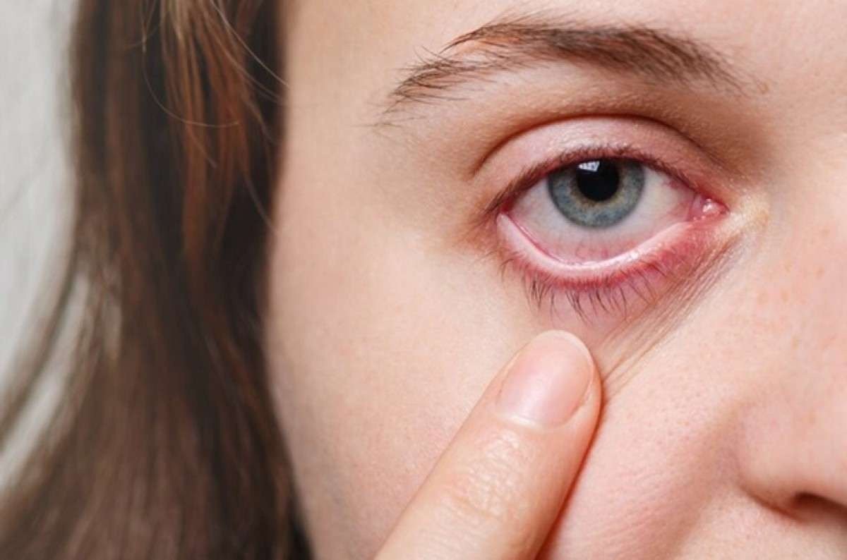 Síndrome do Olho Seco e o uso das telas: qual a relação?
