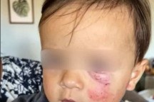 Bebê sofre queimaduras durante banho em creche