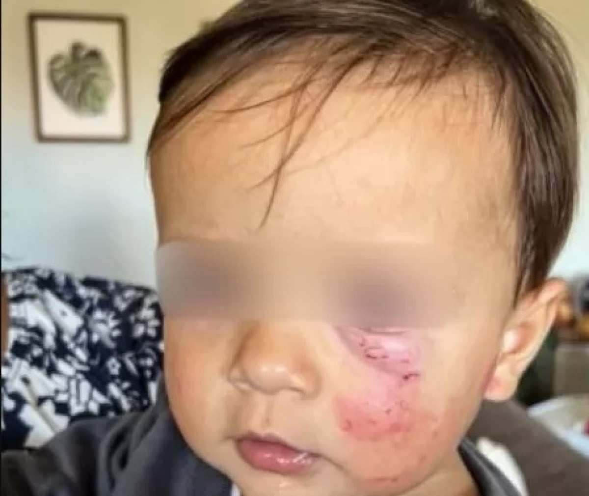 Bebê sofre queimaduras durante banho em creche