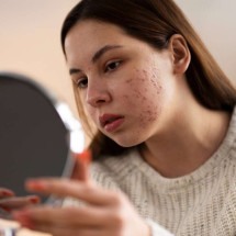 Fumo passivo aumenta risco de dermatite atópica em adolescentes - Freepik
