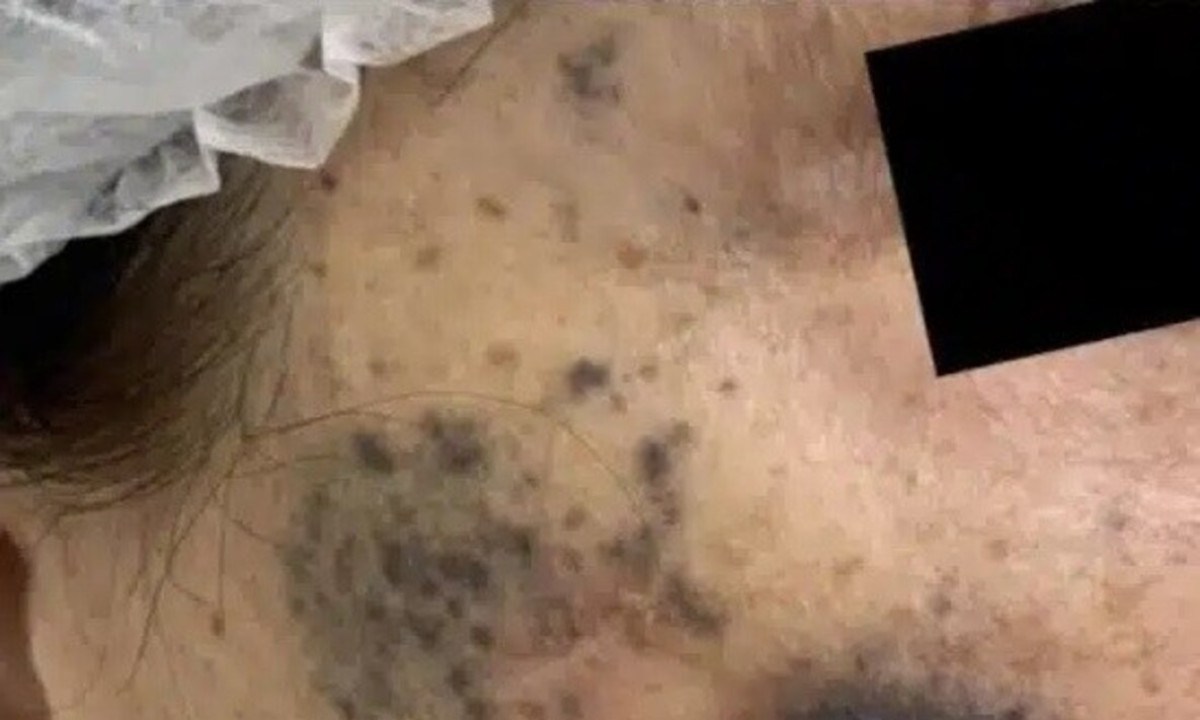 Segundo a dermatologista que atendeu o caso, a vítima teria procurado um médico para tratar um ‘sinal’ pequeno e escuro em seu rosto -  (crédito: Instagram/ Reprodução)