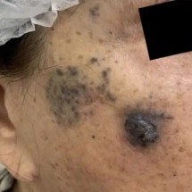 Mulher espalha câncer pelo rosto ao fazer microagulhamento - Instagram/ Reprodução
