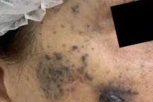 Mulher espalha câncer pelo rosto ao fazer microagulhamento
