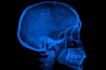 Homem coloca implante dentário e parafuso fica alojado no cérebro