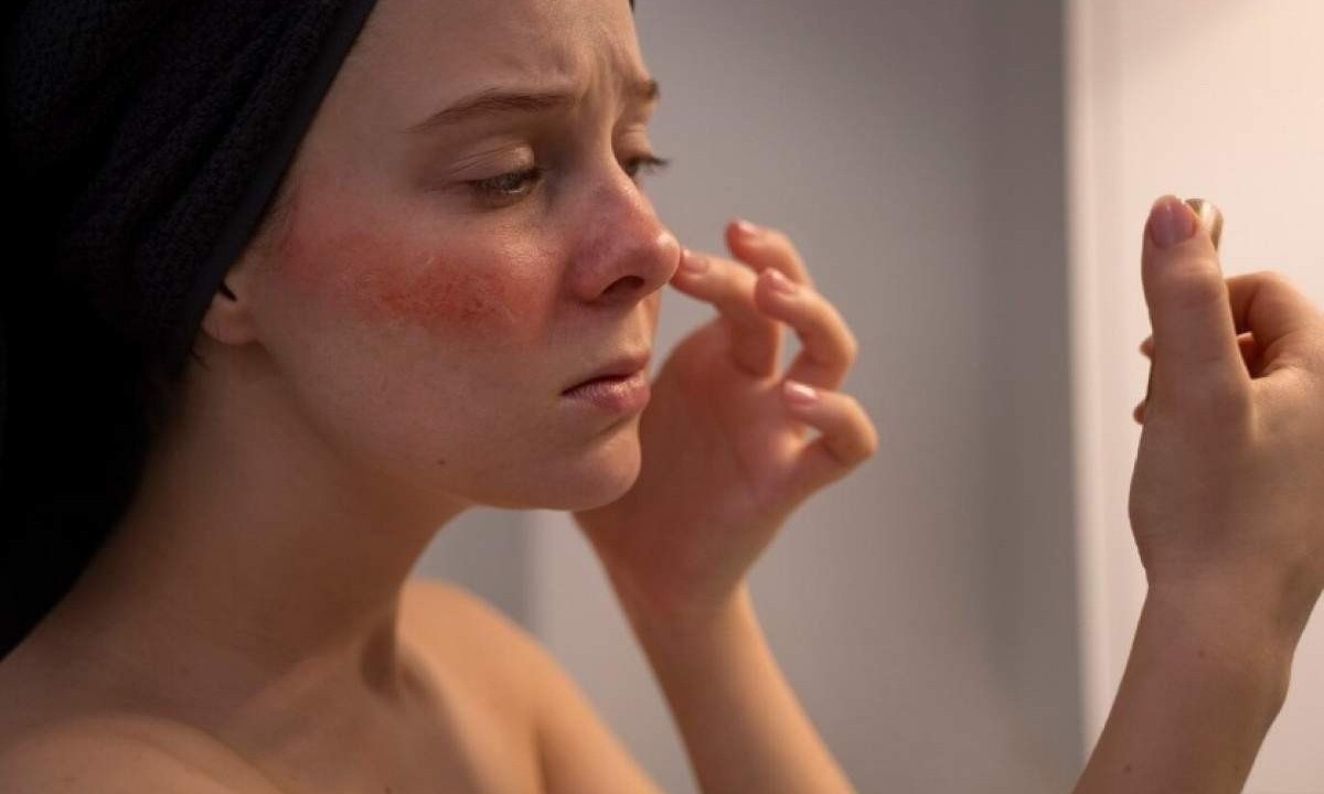 Suas manifestações clínicas mais frequentes são a vermelhidão de face e lesões que lembram o aspecto da acne -  (crédito: Freepik)