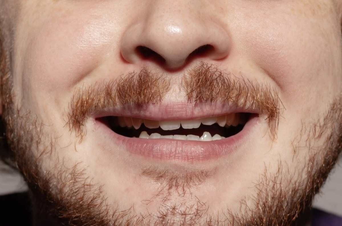 Bruxismo e estresse aceleram envelhecimento dental; entenda 