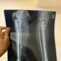 Menina de 6 anos cai de bicicleta e médicos colocam pino em perna errada - pratik patel/Unsplash