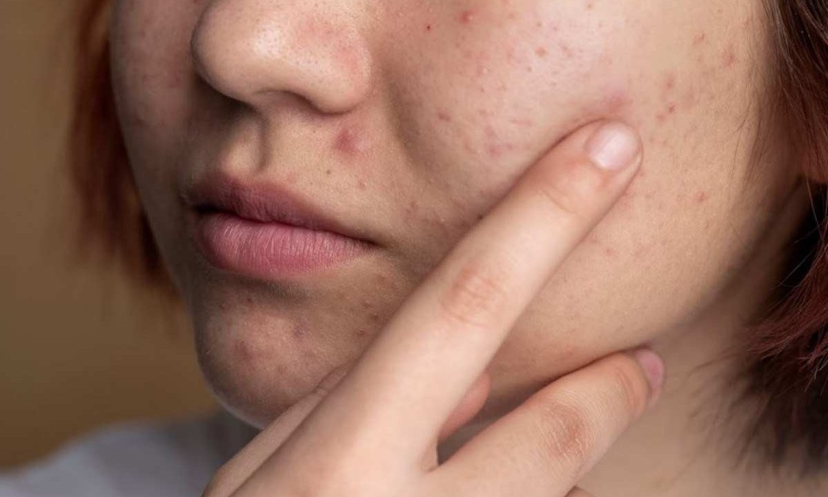 Atualmente, tratamento de casos severos de acne é realizado por meio de medicamentos como isotretinoína e antibióticos, que possuem efeitos colaterais importantes -  (crédito: Freepik)