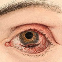 Novo método de terapia pode erradicar melanoma ocular, diz estudo - Wikipedia/Divulgação