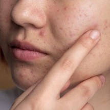 Versão modificada da bactéria causadora da acne é usada para tratar doença - Freepik