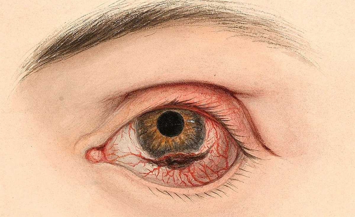 Novo método de terapia pode erradicar melanoma ocular, diz estudo