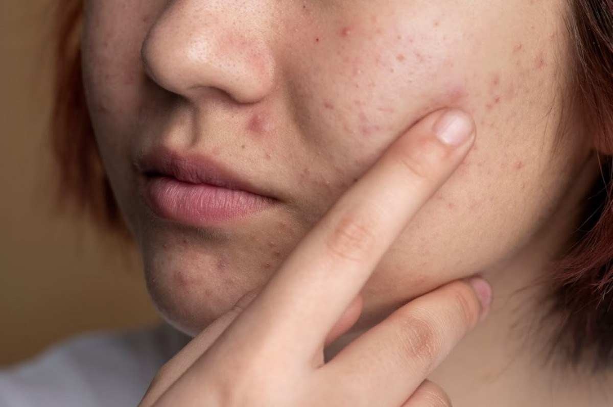 Versão modificada da bactéria causadora da acne é usada para tratar doença