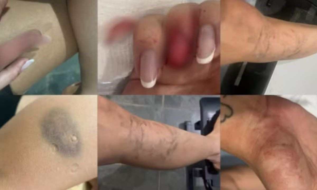 Brenda Lara, agredida por sete mulheres, ficou com diversos hematomas no corpo, além de ter uma de suas unhas arrancadas