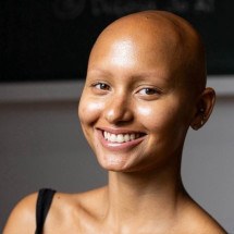 Modelo que nasceu careca desmistifica a alopecia - Linkedin