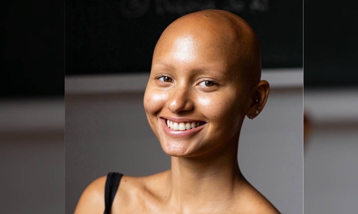 Modelo que nasceu careca desmistifica a alopecia